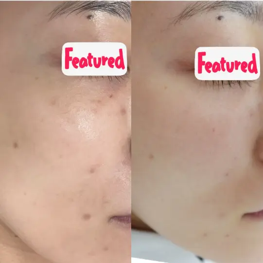 ニキビ跡の色素沈着の症例3